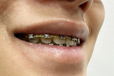 Cẩn trọng cơ sở quảng cáo niềng răng giá rẻ