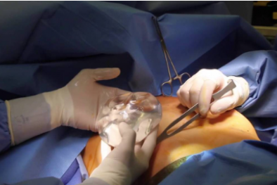 Phẫu thuật nâng ngực bị nhiễm khuẩn gây nhiễm trùng nặng