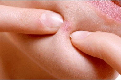 Từ vụ cô gái bị lệch mặt, cảnh báo tác hại nghiêm trọng khi nặn mụn sai cách