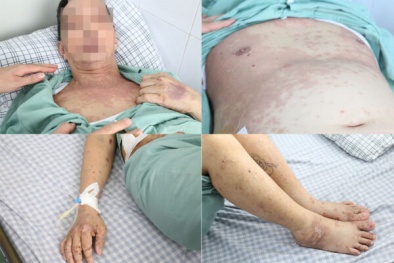 Tự ý dùng thuốc điều trị đau khớp, người đàn ông mắc hội chứng Dress thể dị ứng thuốc hiếm gặp