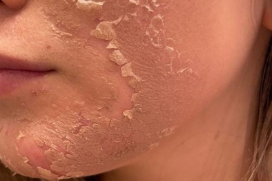 Sưng nề, bội nhiễm do lột da mặt để xóa nám bằng hóa chất mua trên tiktok không rõ thành phần 