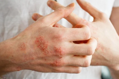 Những dịch bệnh thường gặp sau mùa mưa lũ