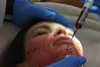 Phương pháp làm đẹp lấy máu tự thân liệu có an toàn?