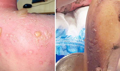 Hệ lụy từ việc điều trị bỏng và bệnh vẩy nến tại nhà bằng thuốc nam