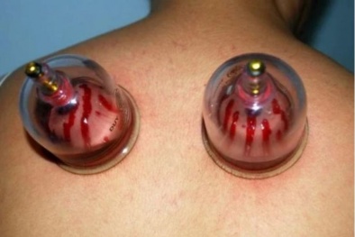 Cảnh báo nguy hiểm khi tự điều trị ung thư theo kinh nghiệm dân gian