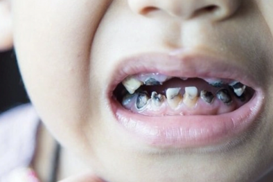 Tỷ lệ sâu răng của trẻ em tại Việt Nam tăng hơn 86% 