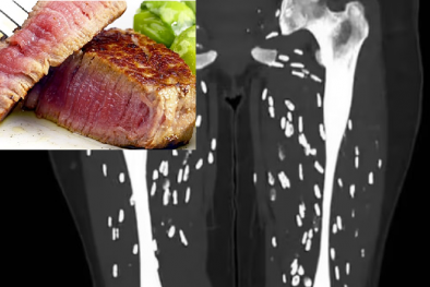 Bác sĩ cấp cứu cảnh báo: Chế biến thịt lợn theo kiểu Hàn Quốc nguy hiểm cho sức khỏe