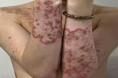 Nấm mọc toàn thân do tự ý bôi thuốc ngứa mua trên mạng không rõ nhãn mác