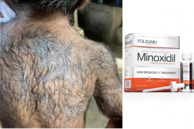 Trẻ mắc chứng 'người sói' nếu bố mẹ dùng thuốc mọc tóc minoxidil khi chăm con