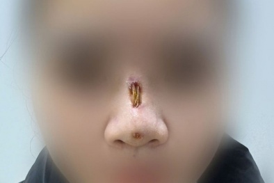 Cảnh báo biến dạng mũi sau 3 tháng căng chỉ