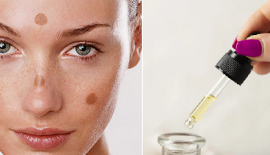 Bác sĩ chỉ ra những thành phần hỗ trợ điều trị nám hiệu quả và cách lựa chọn phù hợp cho da