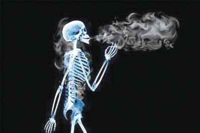 Hút thuốc lá có thể làm tăng nguy cơ loãng xương, gãy xương