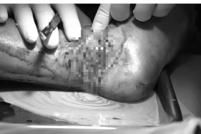 Cảnh báo nhiễm trùng nặng do đắp lá chữa bong gân