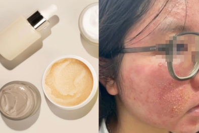 Nổi mẩn đỏ khắp mặt, ngứa rát dữ dội do dùng mỹ phẩm không rõ nguồn gốc