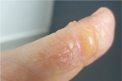 Viêm da nhiễm trùng do điều trị sai cách