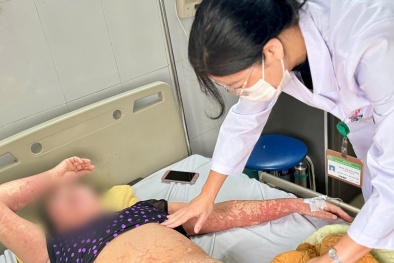 Cảnh báo mặt biến dạng do dị ứng thuốc