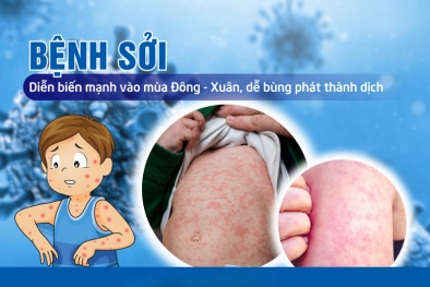 Bộ Y tế ra công văn hỏa tốc về phòng, chống bệnh sởi
