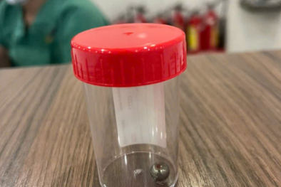 Sử dụng súng đồ chơi khiến bé trai 5 tuổi bị viên bi bắn xuyên má, gãy xương mặt