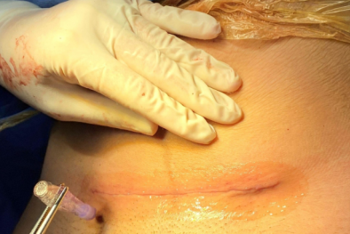 Phát triển keo sinh học mới có khả năng cầm máu nhanh, lưu ý khi dùng để tránh biến chứng