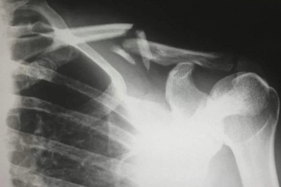 Nằm giường cũng gãy xương do lạm dụng kem chống nắng: Cảnh báo thói quen phản tác dụng