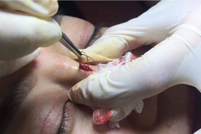 Nâng mũi bằng chỉ – đẹp chưa thấy, biến dạng đã đến