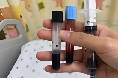 Bé gái nguy kịch vì ngộ độc máu sau bữa canh ghẹ