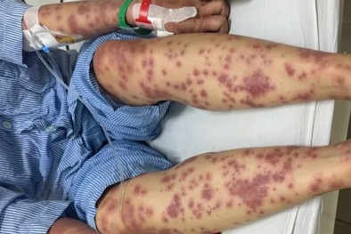 Nguy kịch vì dùng thuốc giảm cân, collagen không rõ nguồn gốc