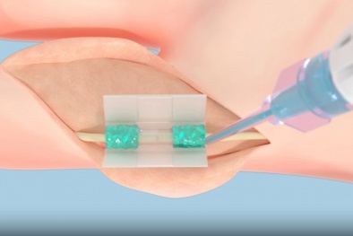 Phát triển polymer sinh học kích hoạt bằng ánh sáng có thể thay thế chỉ khâu trong phẫu thuật