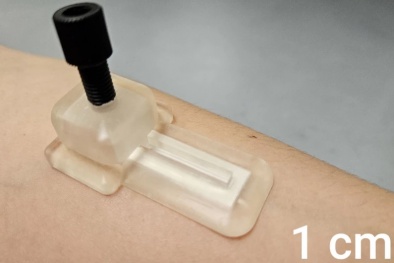 Miếng dán vi kim thông minh: Công nghệ thay thế lấy mẫu máu truyền thống