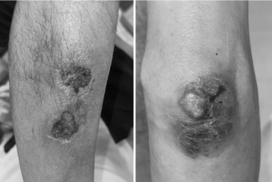 Ngộ độc methotrexate: Sai một liều, trả giá bằng sức khỏe