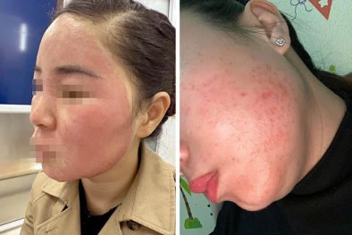 Tretinoin là thuốc kê đơn không nên tự ý dùng để làm đẹp 'cấp tốc' vì tiềm ẩn nhiều nguy cơ